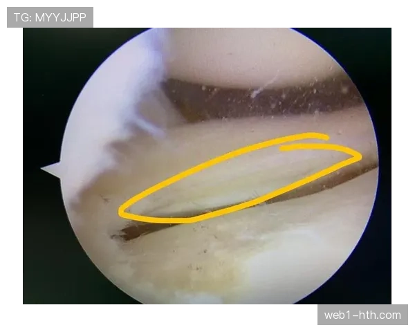山东泰山进攻核心克雷桑左膝半月板韧带损伤 具体恢复时间待定